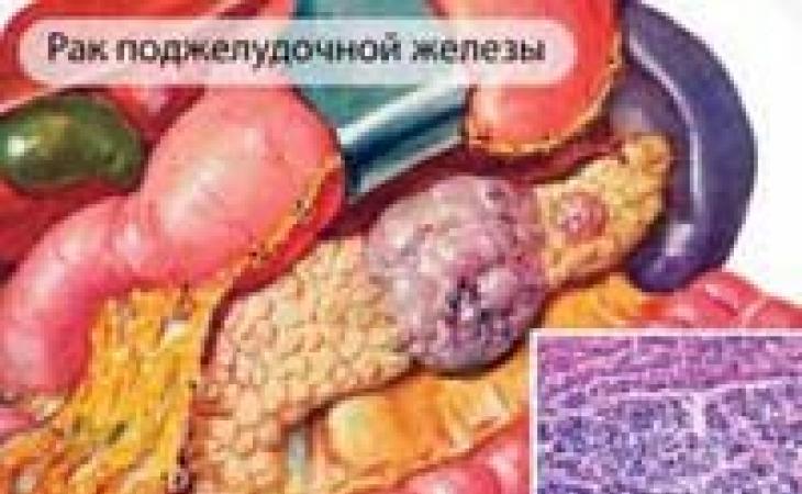 Рак поджелудочной железы - этиология, патогенез, клиническая картина Рак поджелудочной железы этиология и патогенез